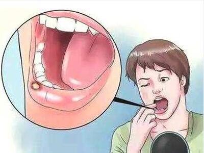口腔溃疡平时生活饮食需要注意什么?